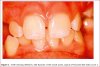 Fluorosis Risk Index Scoe 2.JPG