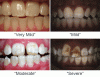 fluorosis-comp.gif